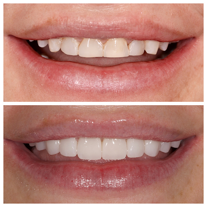 Cosmetic Veneers Jupiter Fl