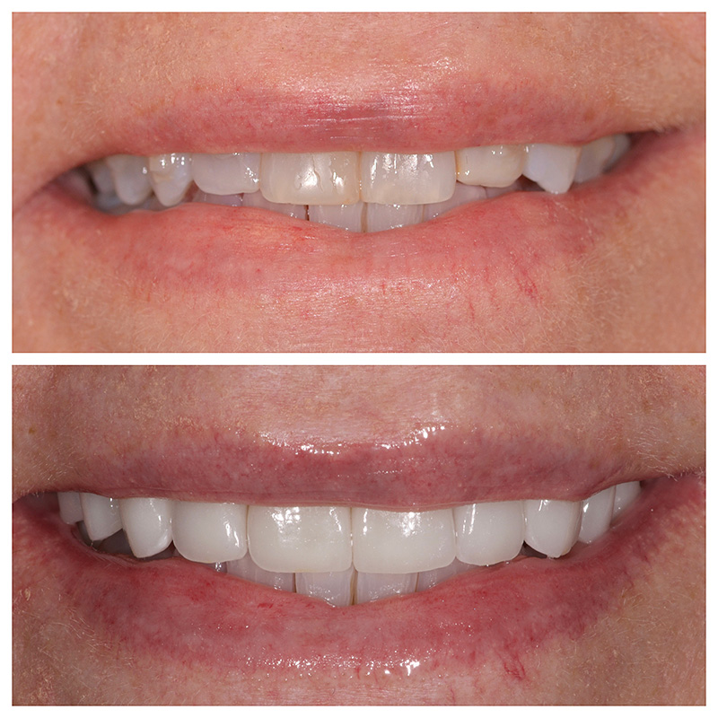 Cosmetic Veneers Jupiter Fl