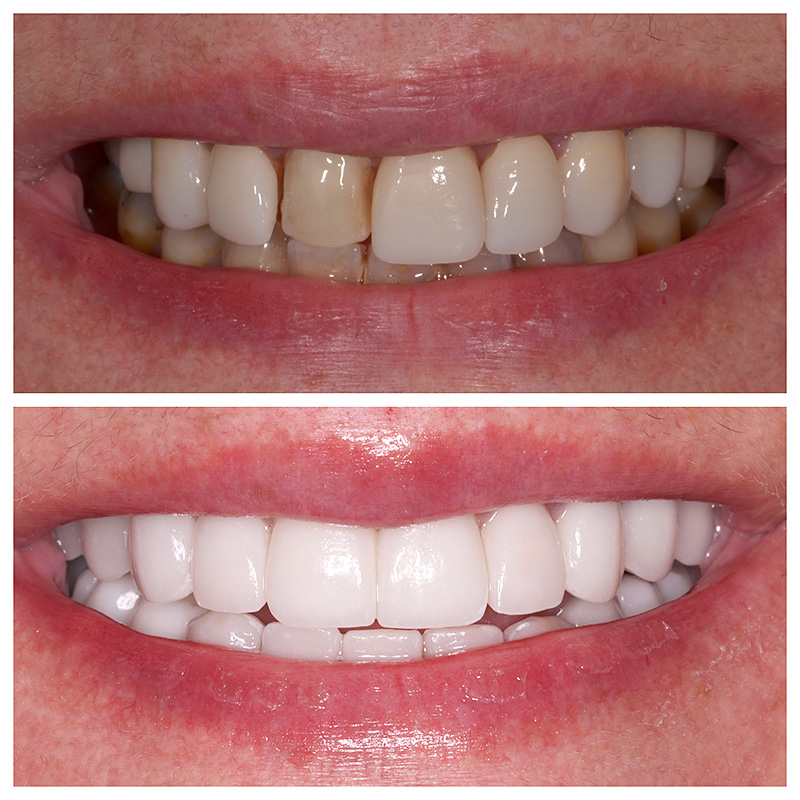 Cosmetic Veneers Jupiter Fl