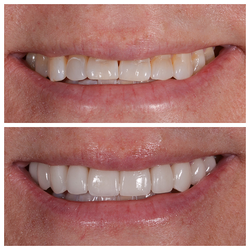 Cosmetic Veneers Jupiter Fl