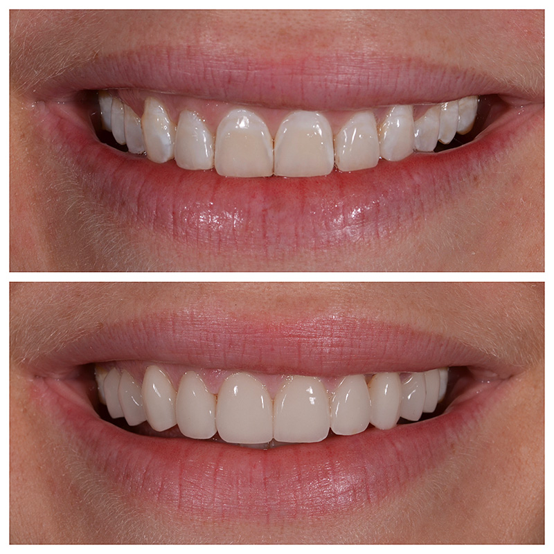 Cosmetic Veneers Jupiter Fl