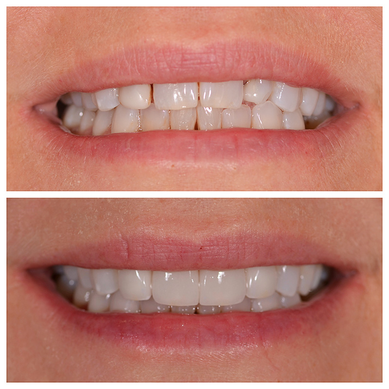 Cosmetic Veneers Jupiter Fl