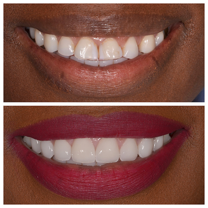 Cosmetic Veneers Jupiter Fl