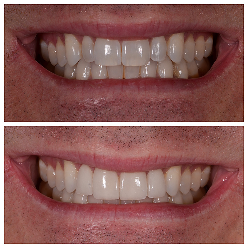 Cosmetic Veneers Jupiter Fl