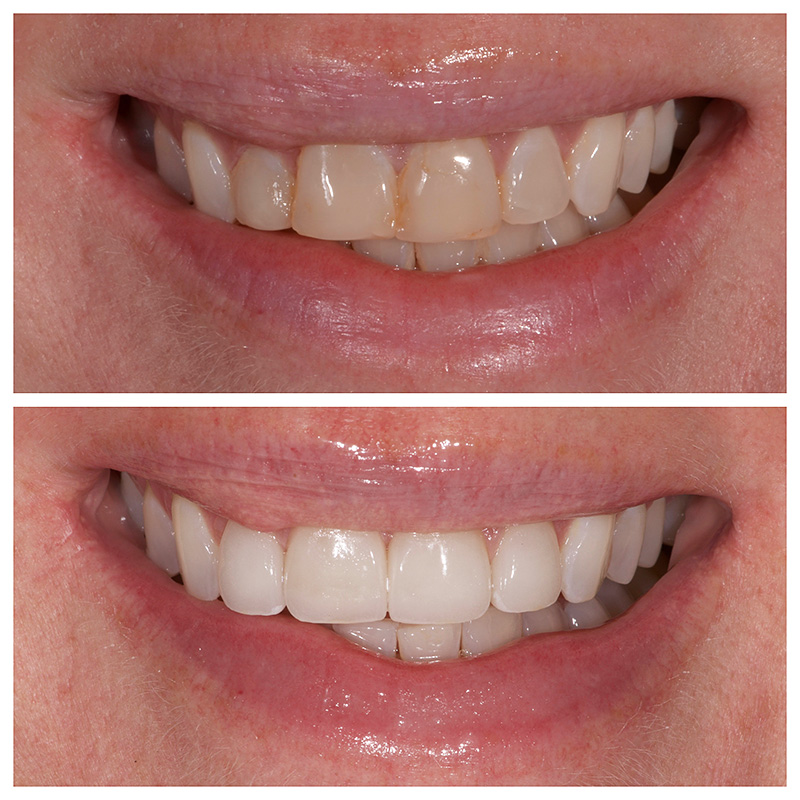 Cosmetic Veneers Jupiter Fl