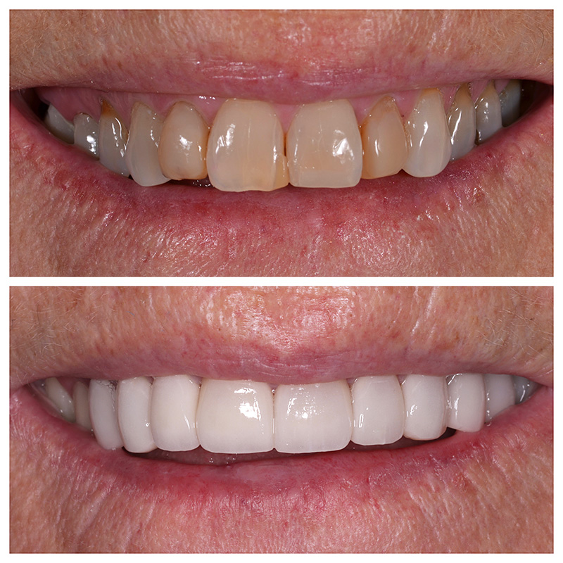 Cosmetic Veneers Jupiter Fl